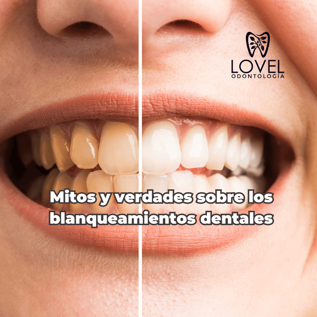 Mitos Y Verdades Sobre Los Blanqueamientos Dentales