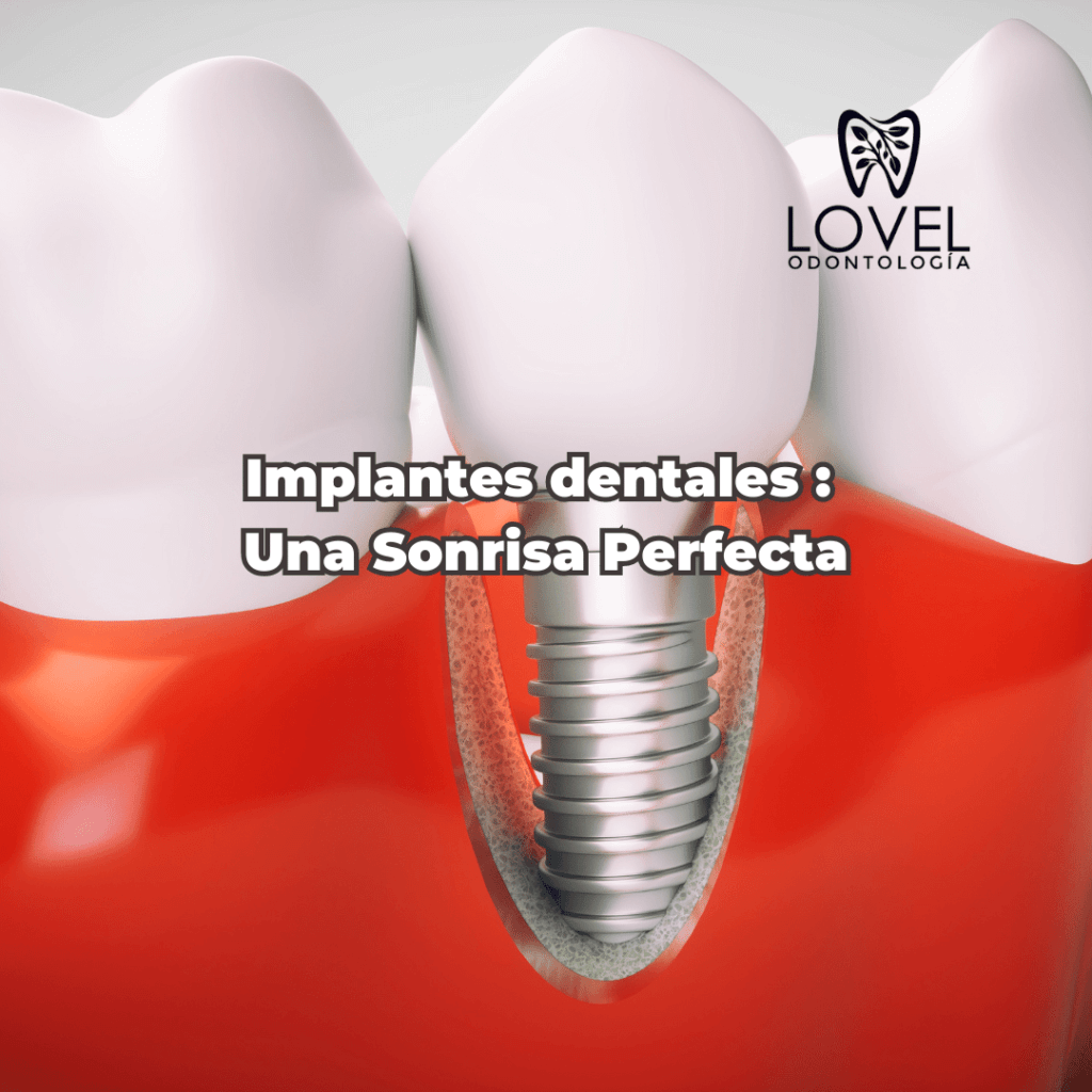 Los implantes dentales, tu mejor solución