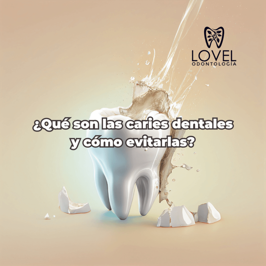 ¿Qué son las caries dentales y cómo evitarlas? Aquí en lovel odontología te contamos cómo.