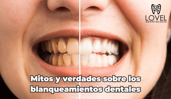 Mitos y verdades sobre los blanqueamientos dentales