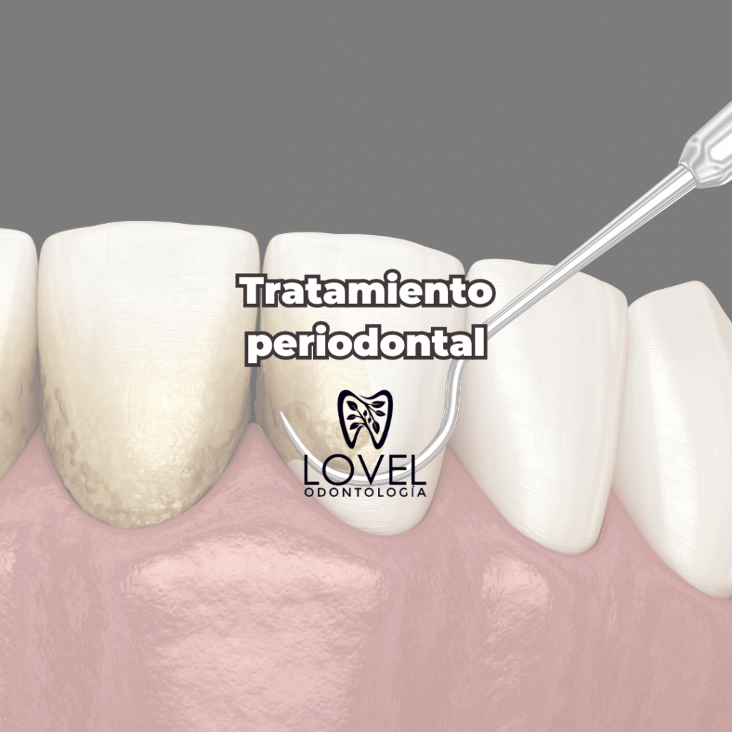 Tratamiento periodontal