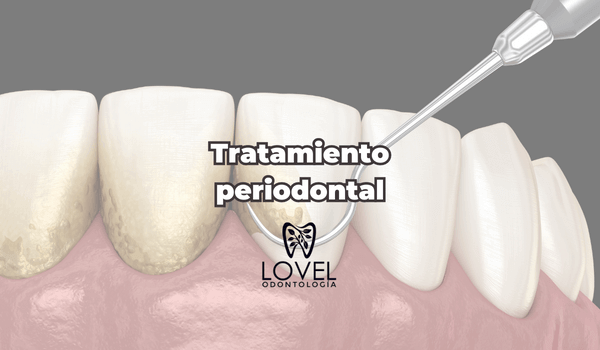 Tratamiento periodontal