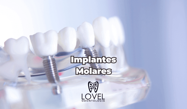 Implantes Molares