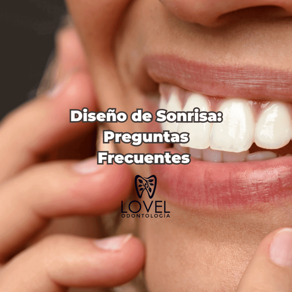 Diseño de Sonrisa: Preguntas Frecuentes 