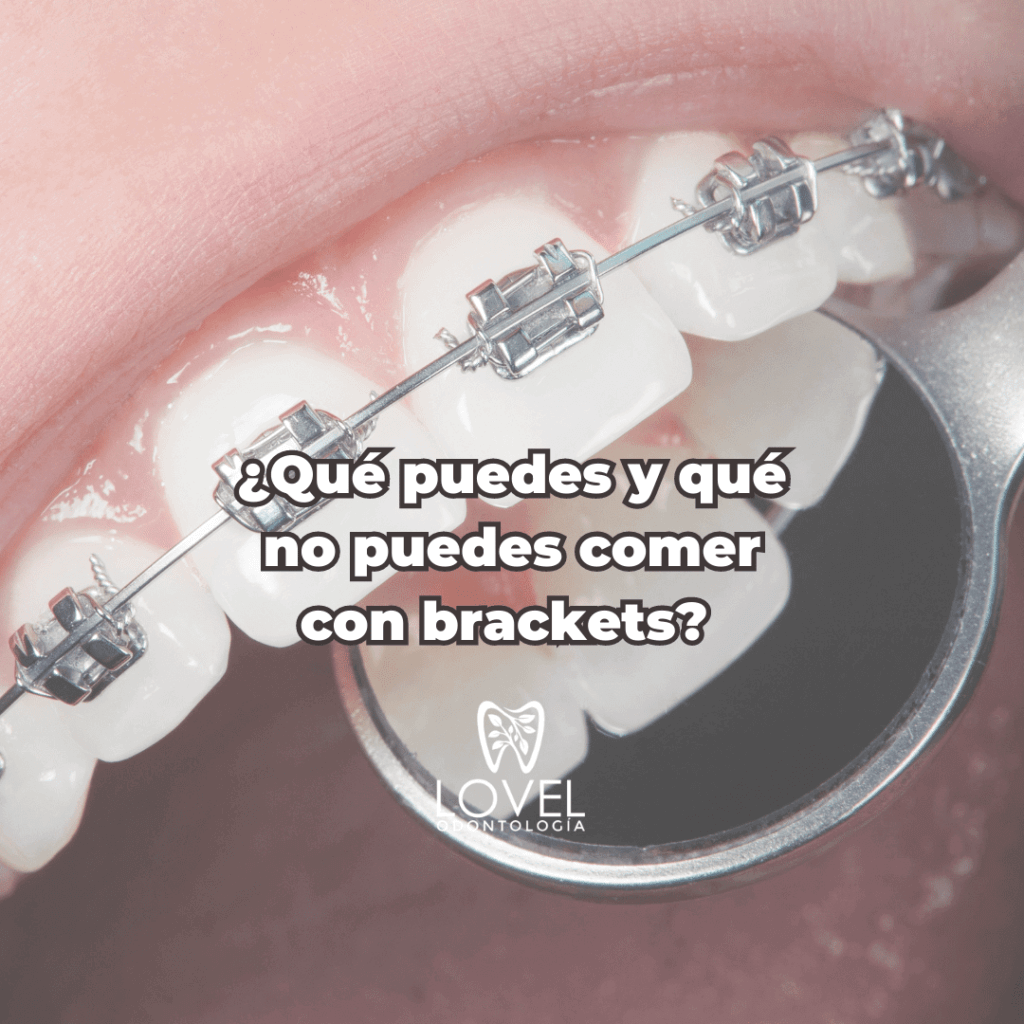 ¿Qué puedes y qué no puedes comer con brackets?