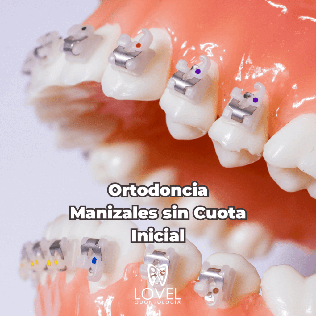 Ortodoncia Manizales sin Cuota Inicialde Prótesis Dentales