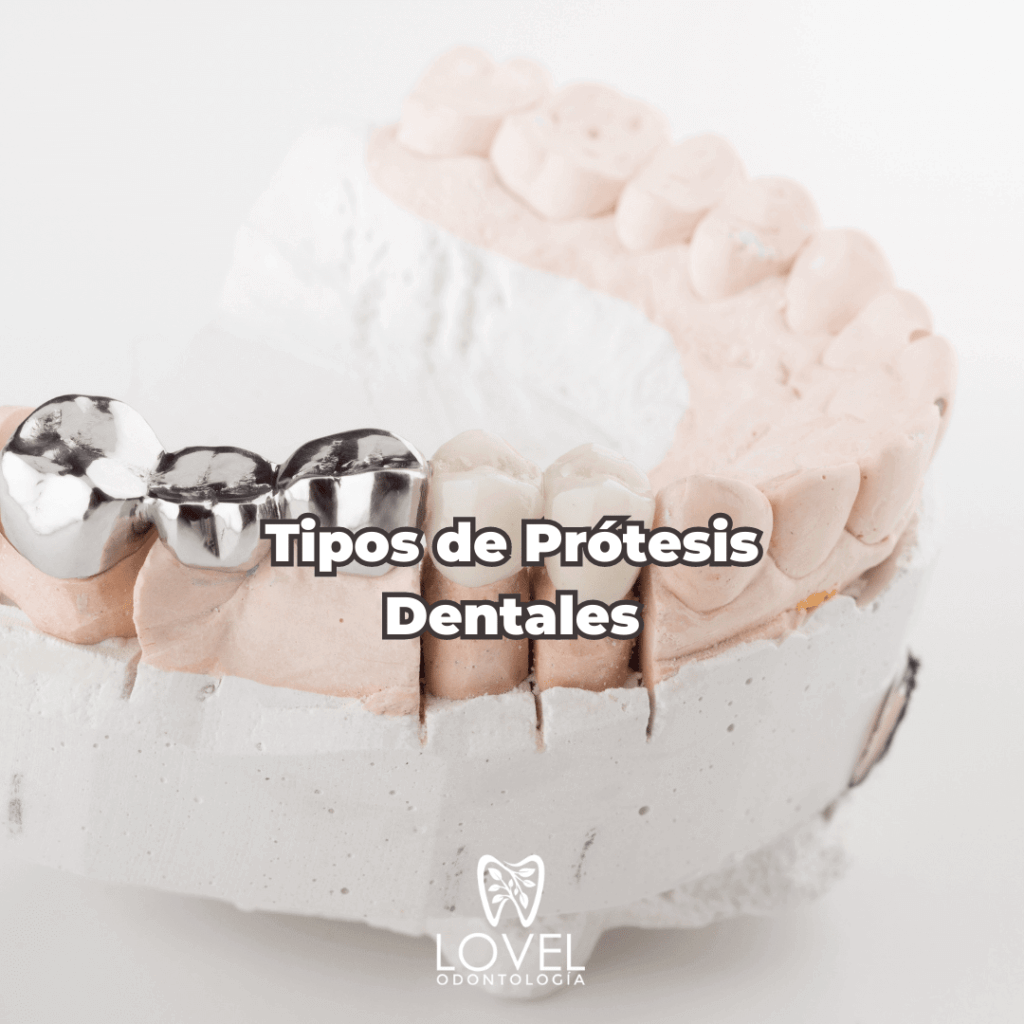 Tipos de prótesis dentales