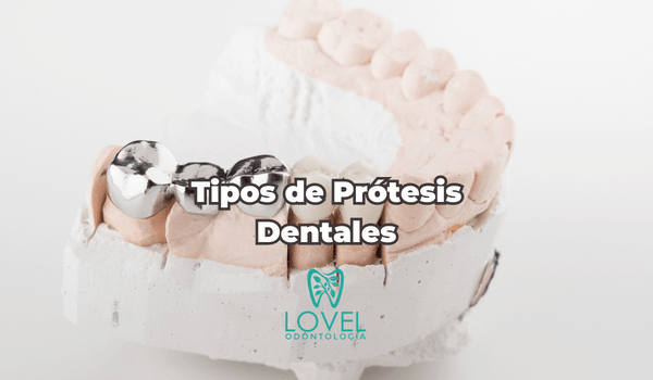 Tipos De Prótesis Dentales